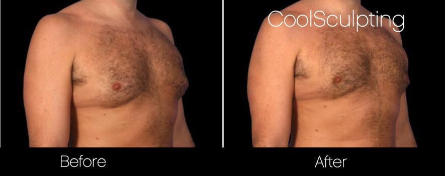 CoolSculpting - Before and After Gallery – Photo 56