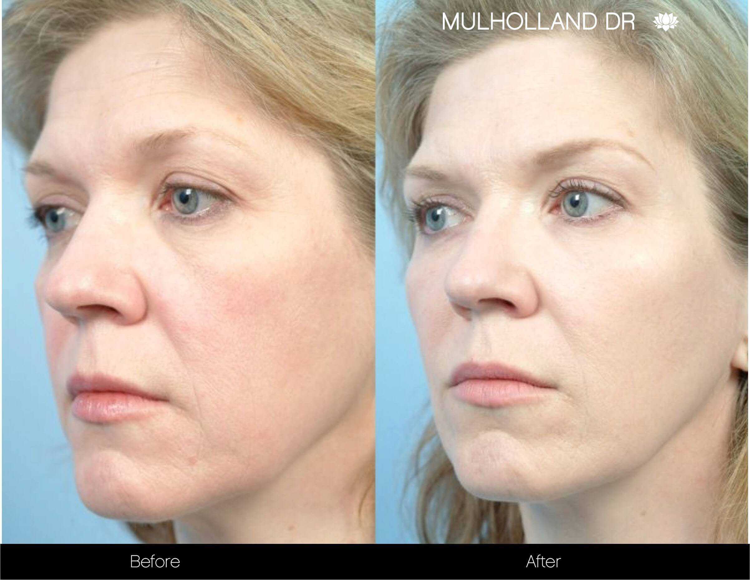 Soft Tissue Fillers - Patient Before and After Gallery – Photo 109