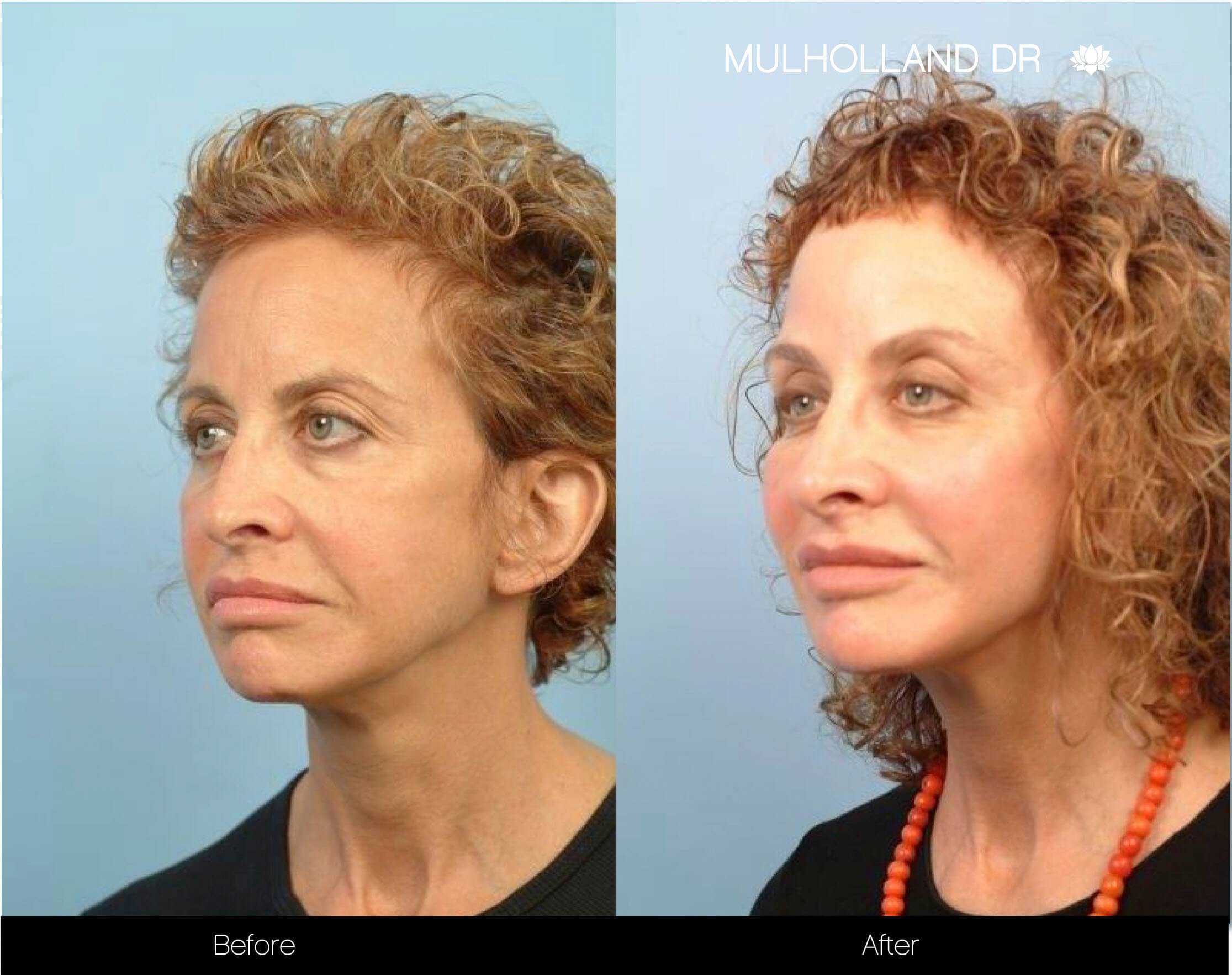 Soft Tissue Fillers - Patient Before and After Gallery – Photo 92