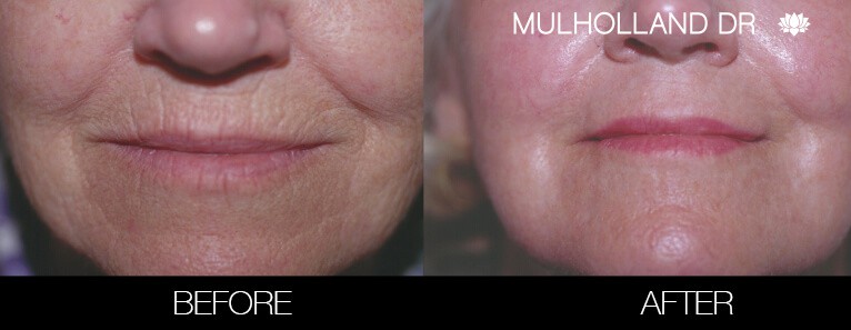 Fractional Erbium Laser - Before and After Gallery – Photo 36