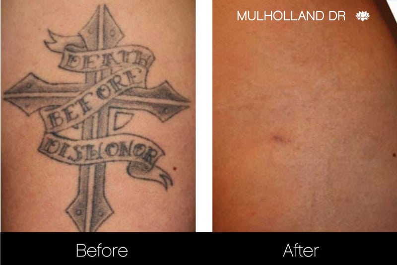 picoway tattoo removal aftercare