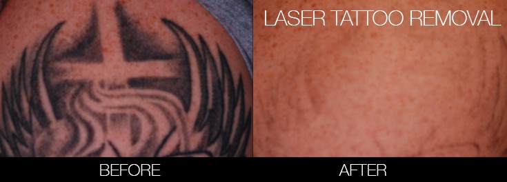 Laser Tattoo Removal Clinic Toronto See Our Before Afters