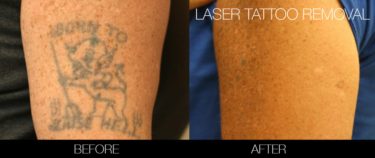 Does Laser Tattoo Removal Hurt? - Este