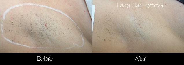 29+ Ingrown Hair Vag Brazilian Laser Hair Removal Results Images