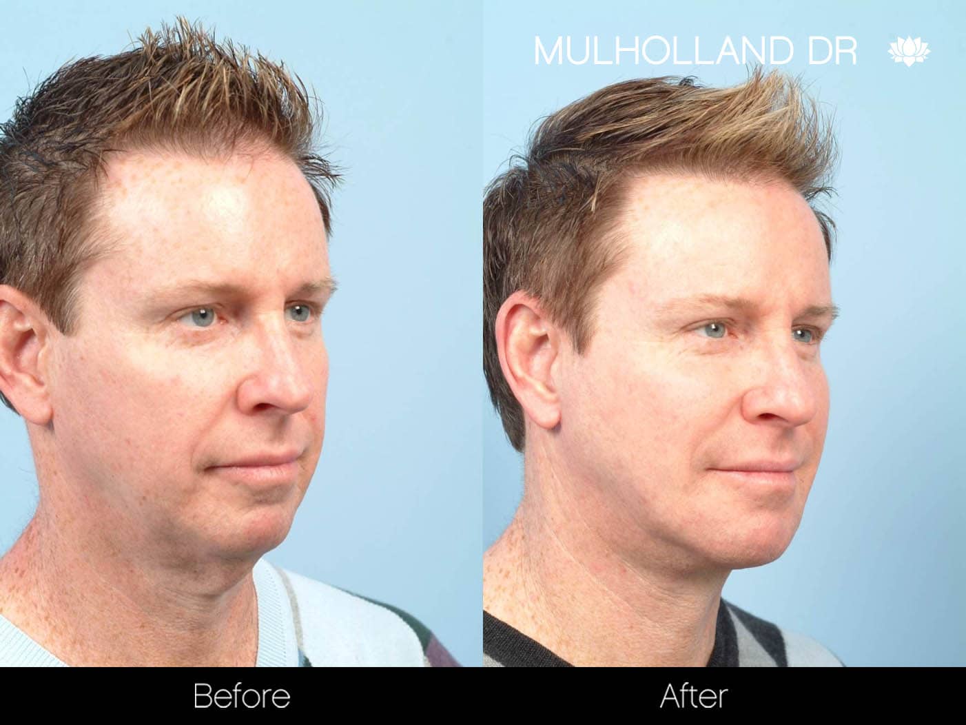 Tumescent Liposuction - Before and After Gallery – Photo 103