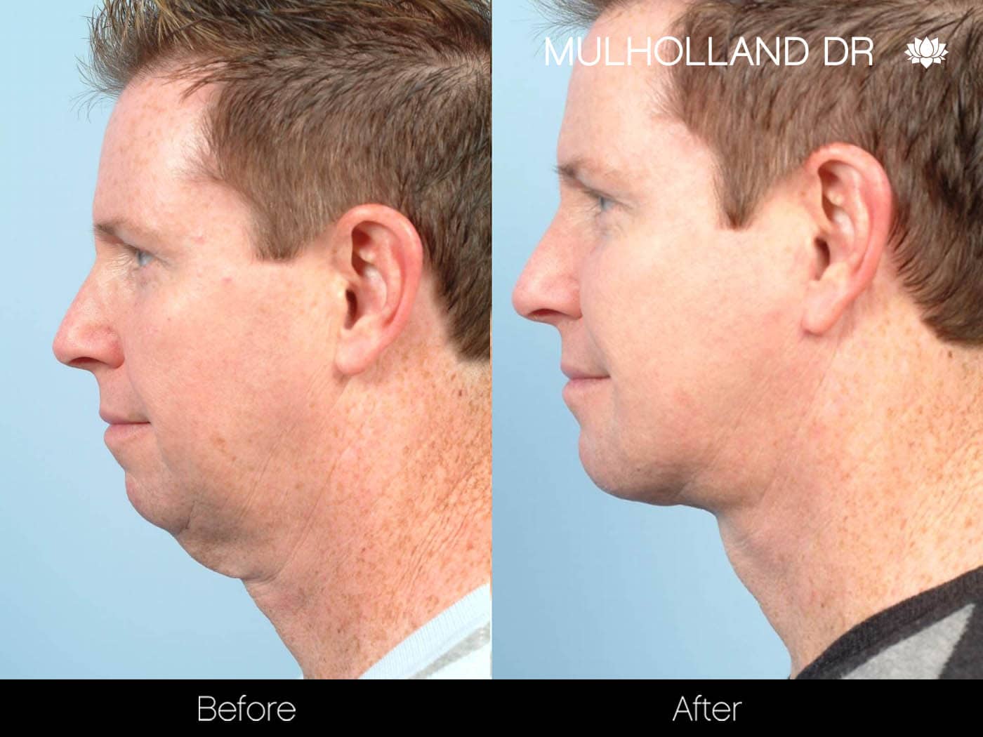 Tumescent Liposuction - Before and After Gallery – Photo 104