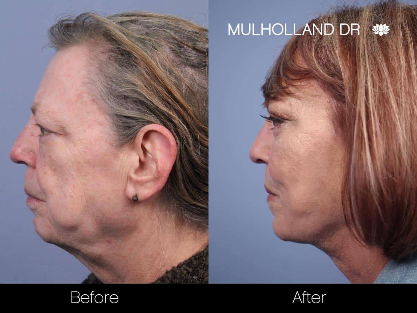 Facial Fat Transfer - Before and After Gallery – Photo 24