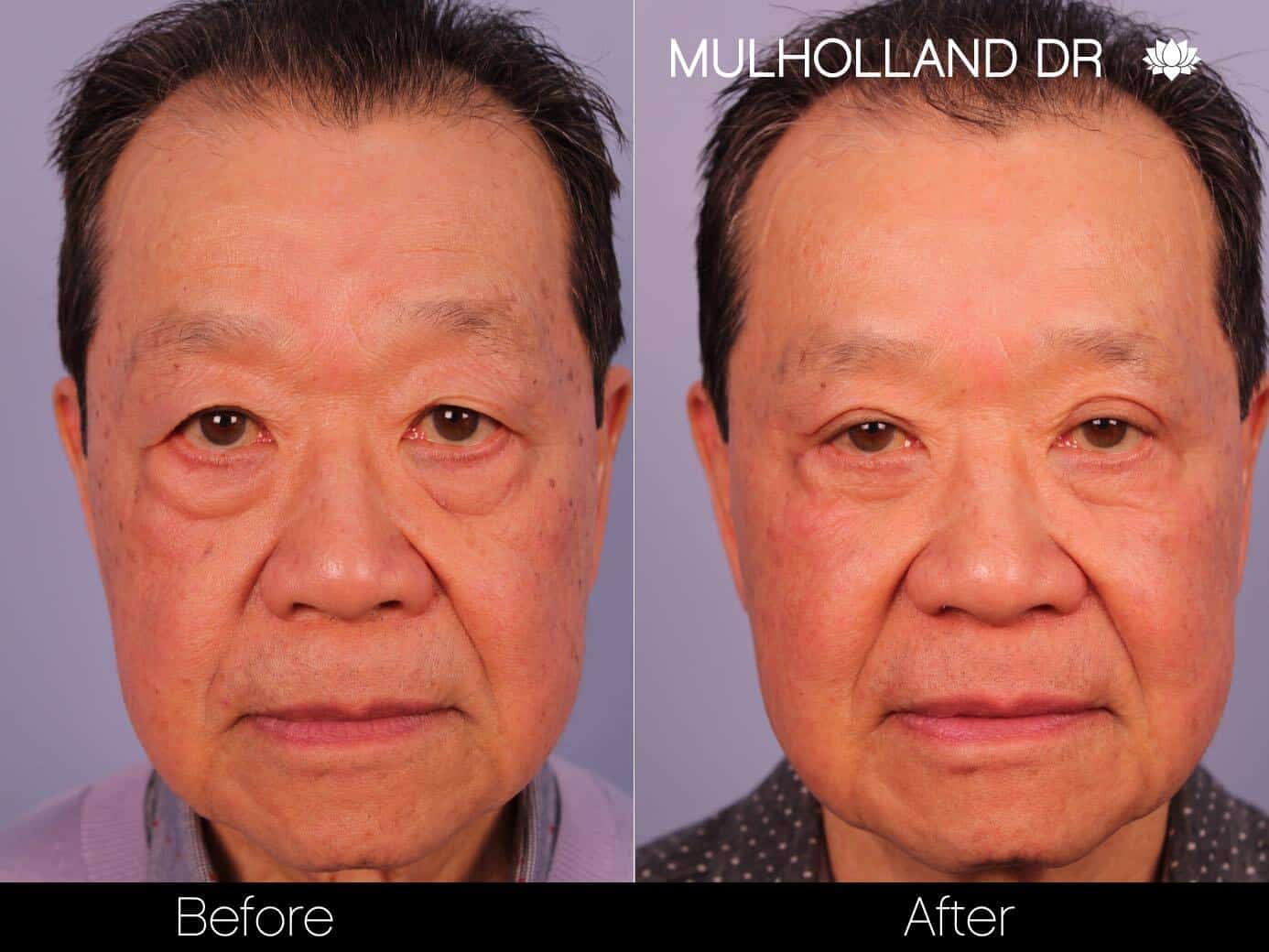 Asian Blepharoplasty - Patient 2 - Spamedica