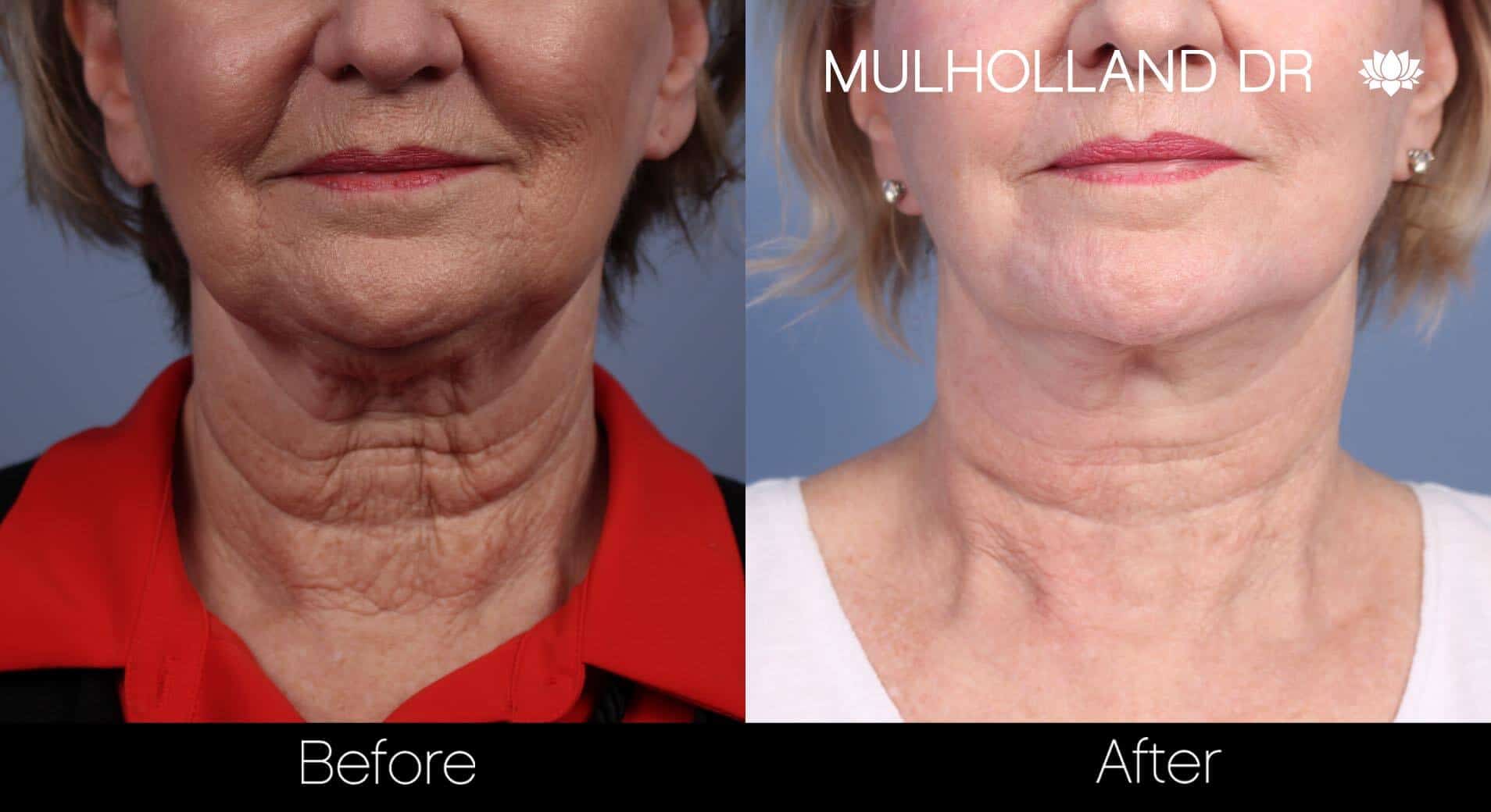 35% Off - Get Rid Of 8 Types Of Wrinkles With Premier Ultra Lift - Premier  Clinic