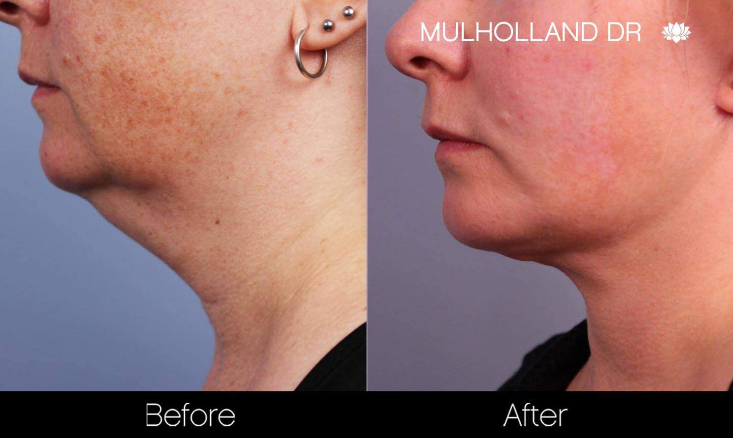 Neck Lift- Before and After Gallery – Photo 90