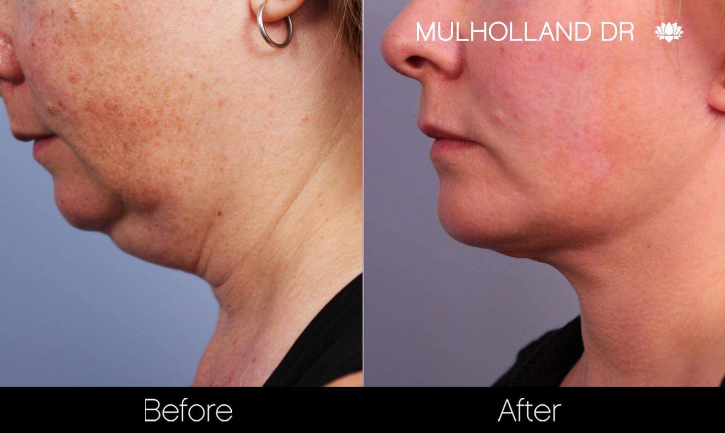 Neck Lift- Before and After Gallery – Photo 91