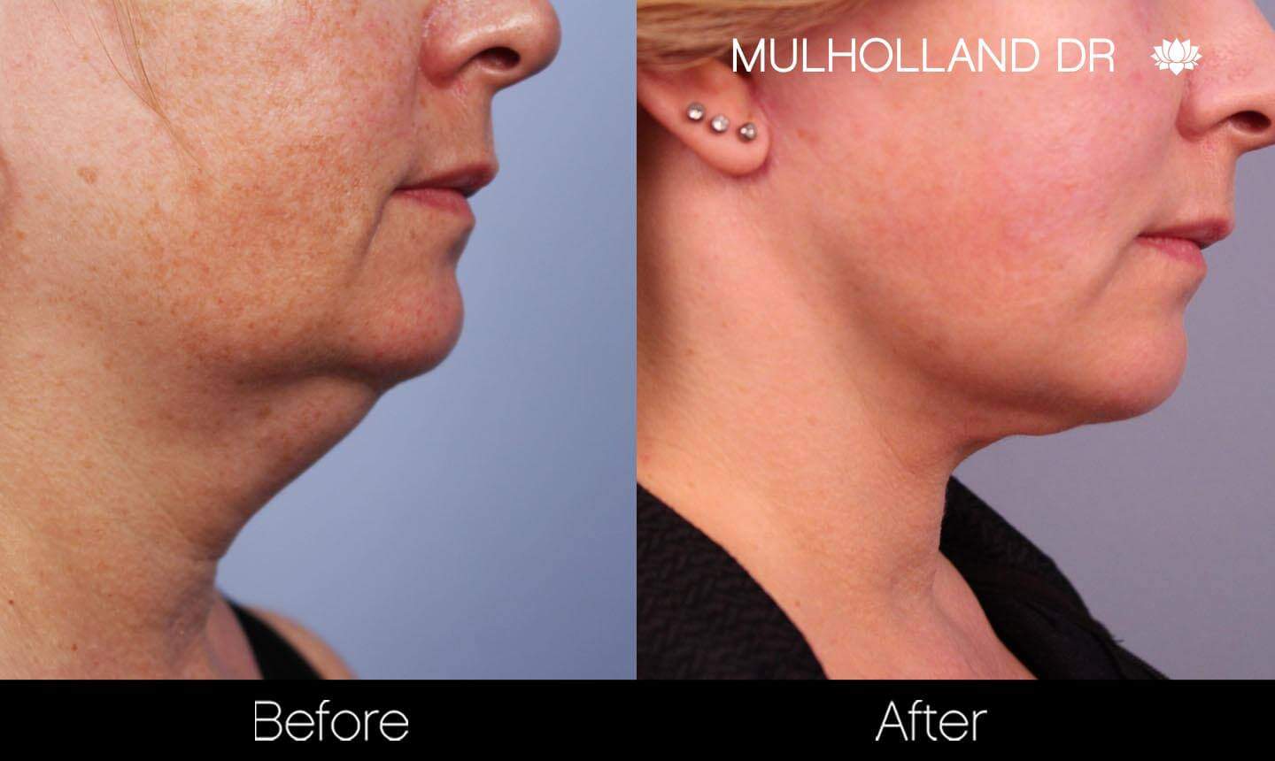 Neck Lift- Before and After Gallery – Photo 92