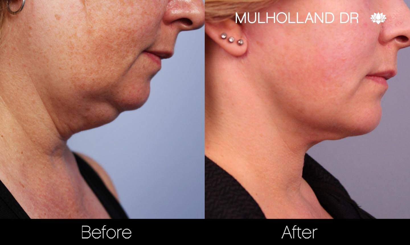 Neck Lift- Before and After Gallery – Photo 93