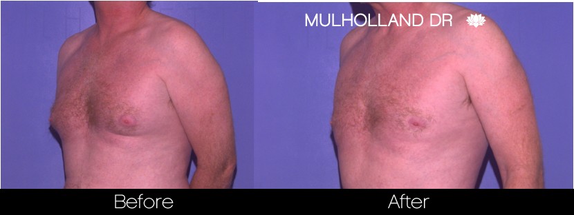 BodyTite Liposuction - Before and After Gallery – Photo 98