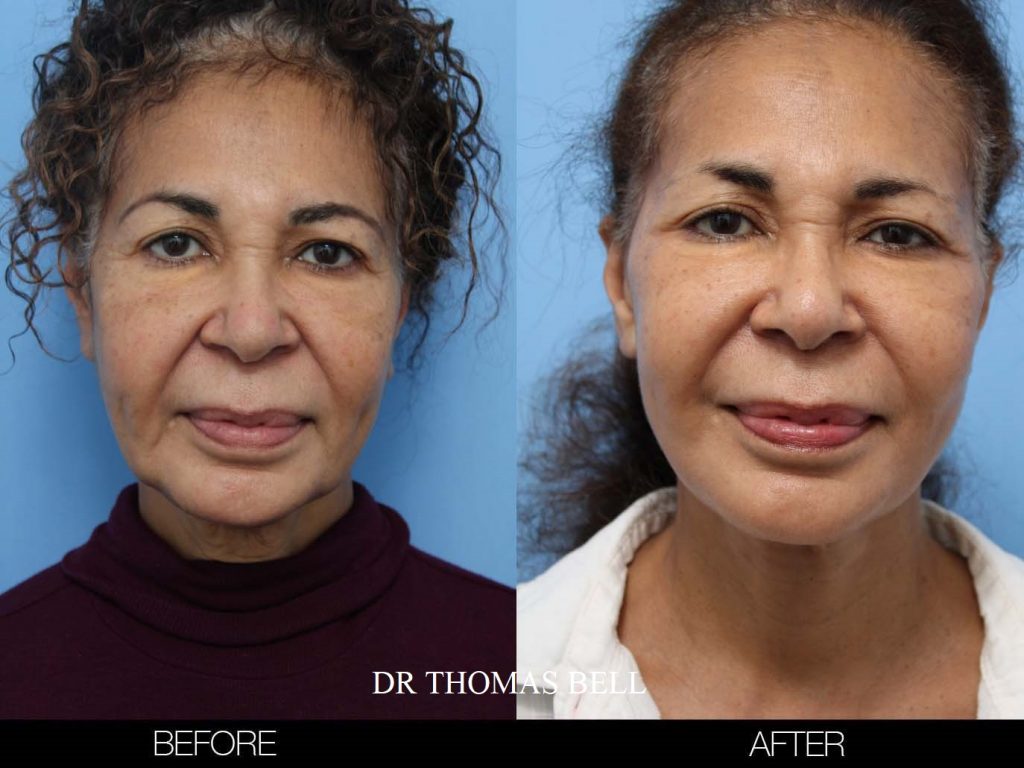 Toronto Facelift Surgeons - Deep Plane Facelift | SpaMedica