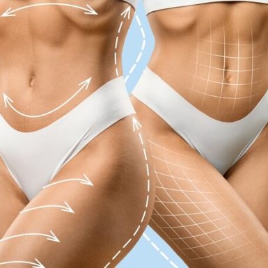 Before and after comparison of a woman's toned abdomen and thighs, highlighting body contouring results, relevant to EMSculpt vs. CoolSculpting treatments.