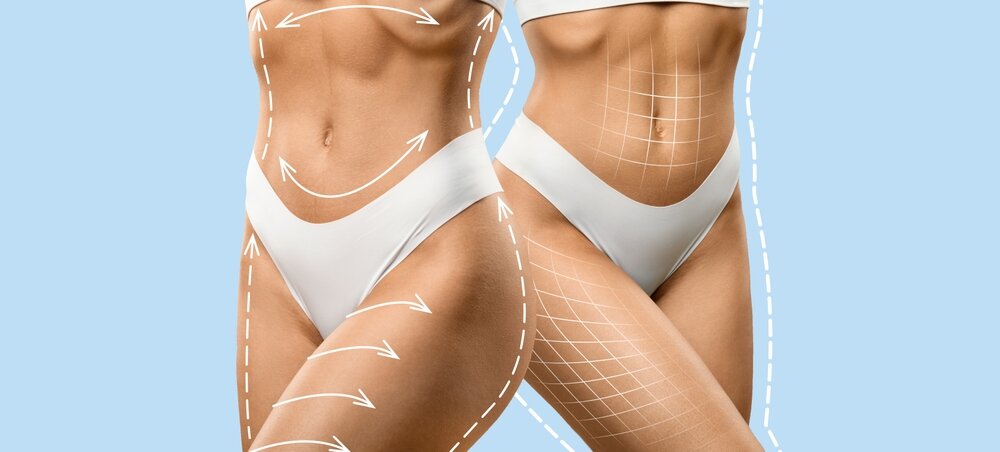 Before and after comparison of a woman's toned abdomen and thighs, highlighting body contouring results, relevant to EMSculpt vs. CoolSculpting treatments.