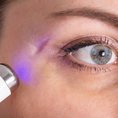 Close-up of a laser scar removal treatment on a woman's face in Toronto.