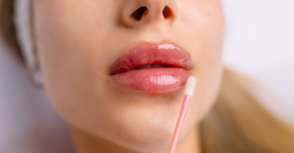 Close-up of a woman’s lips during a cosmetic procedure, illustrating lip filler migration concerns