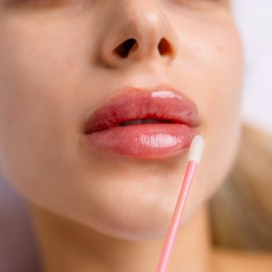 Close-up of a woman’s lips during a cosmetic procedure, illustrating lip filler migration concerns