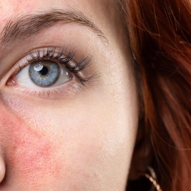 Close-up of a woman’s face showing redness and inflammation characteristic of rosacea.